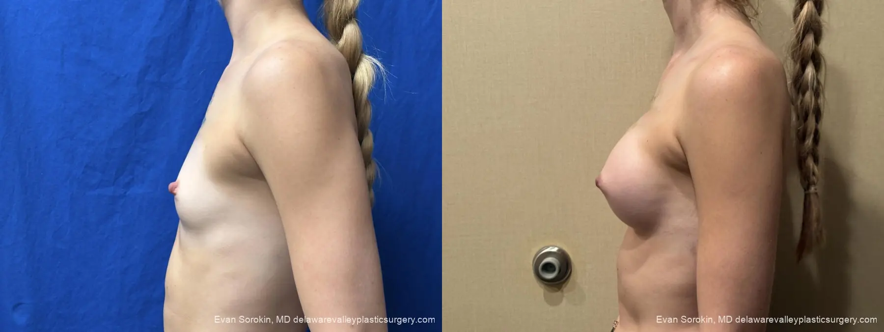 Breast Augmentation: Patient 267 - Before and After 5