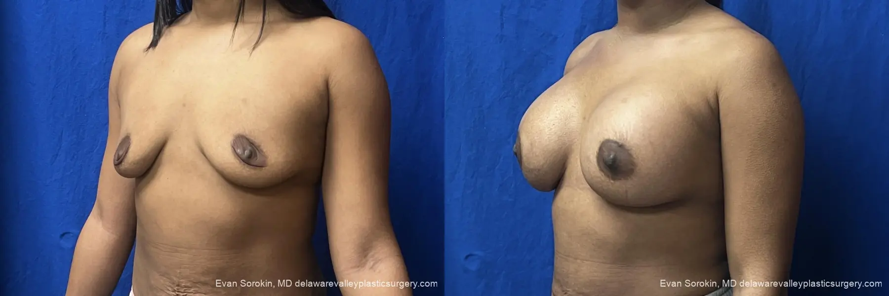 Breast Augmentation: Patient 271 - Before and After 4