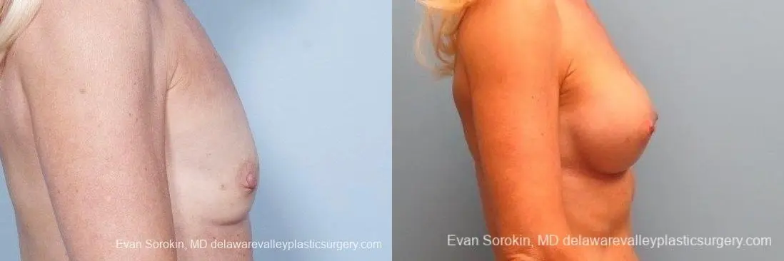 Philadelphia Breast Augmentation 8770 - Before and After 4
