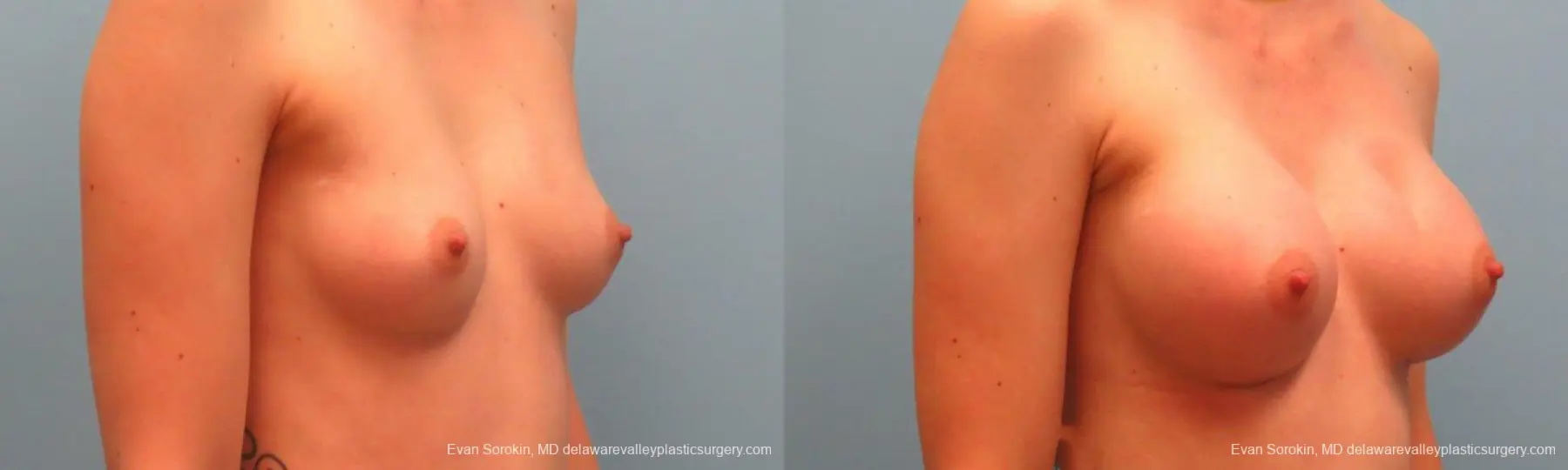 Philadelphia Breast Augmentation 9381 - Before and After 2