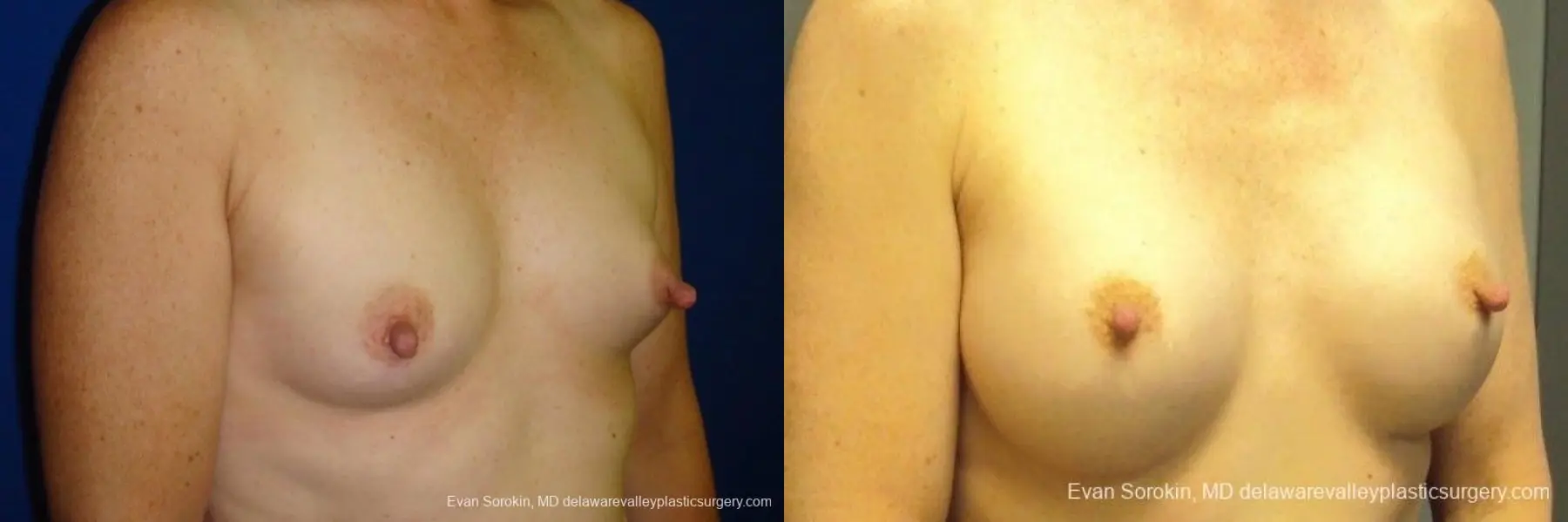 Philadelphia Breast Augmentation 8765 - Before and After 2