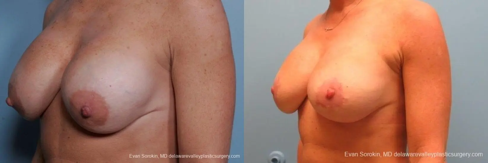 Philadelphia Breast Augmentation 8693 - Before and After 3