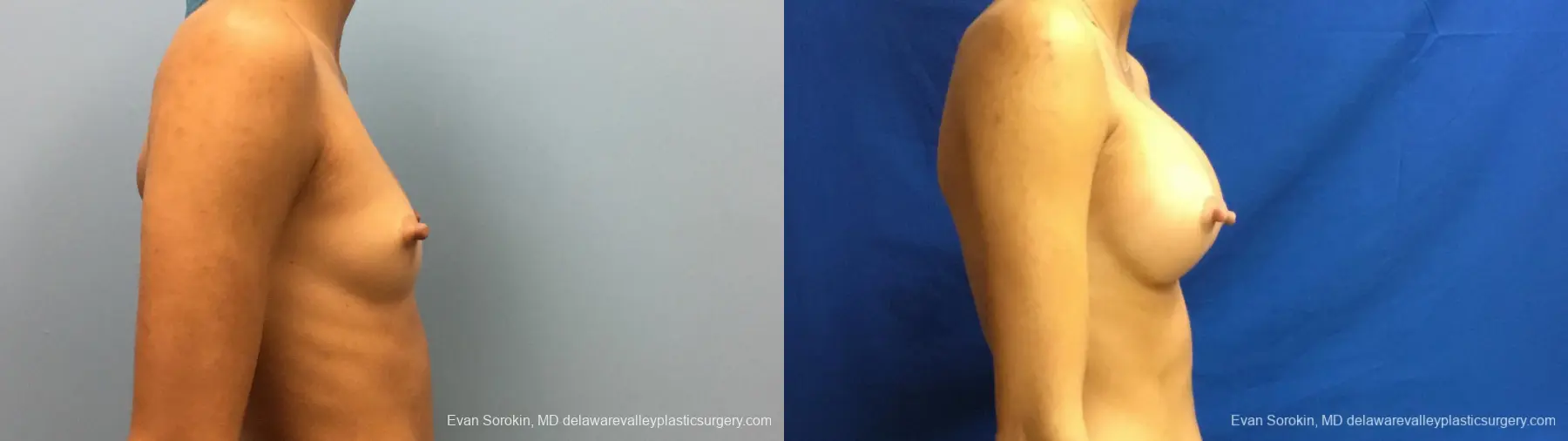 Philadelphia Breast Augmentation 13176 - Before and After 3