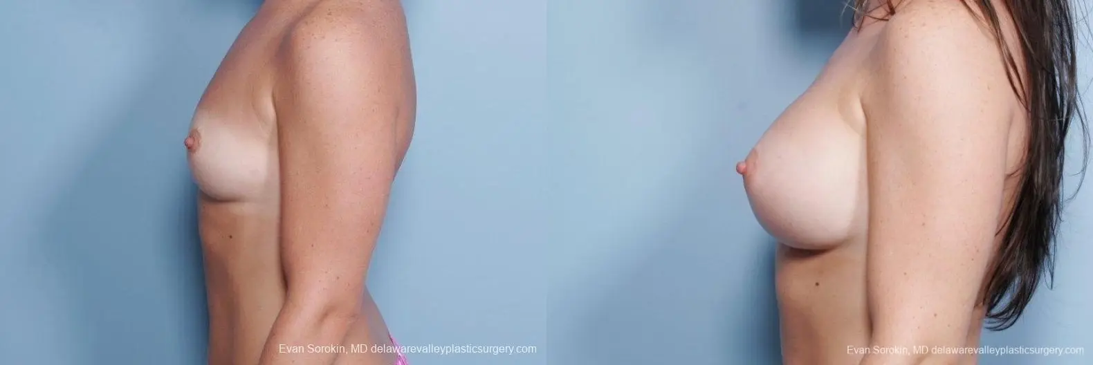 Philadelphia Breast Augmentation 8785 - Before and After 5