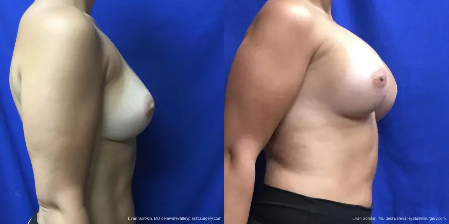 Breast Augmentation Revision: Patient 28 - Before and After 3