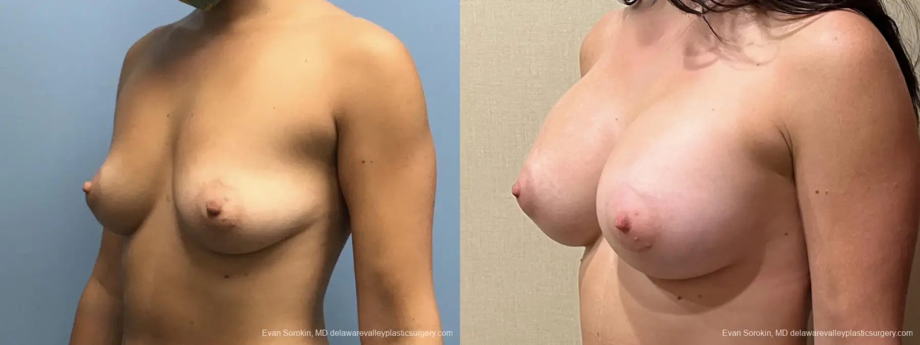 Breast Augmentation: Patient 204 - Before and After 4