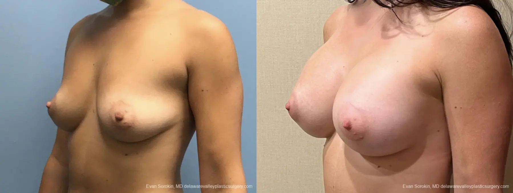 Breast Augmentation: Patient 206 - Before and After 4