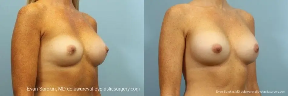 Philadelphia Breast Augmentation 8654 - Before and After 2