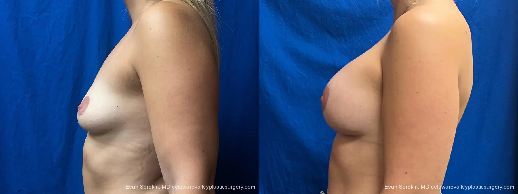 Breast Augmentation: Patient 326 - Before and After 5