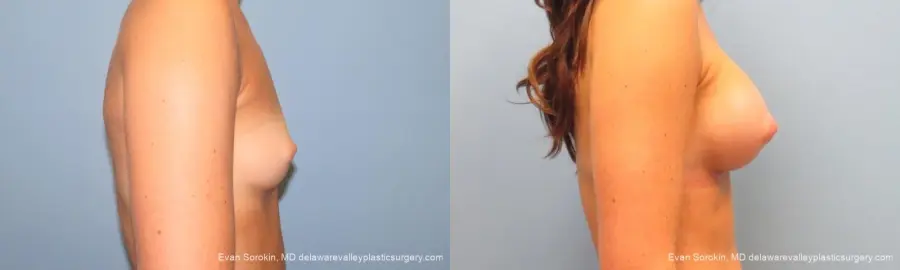 Philadelphia Breast Augmentation 9621 - Before and After 3