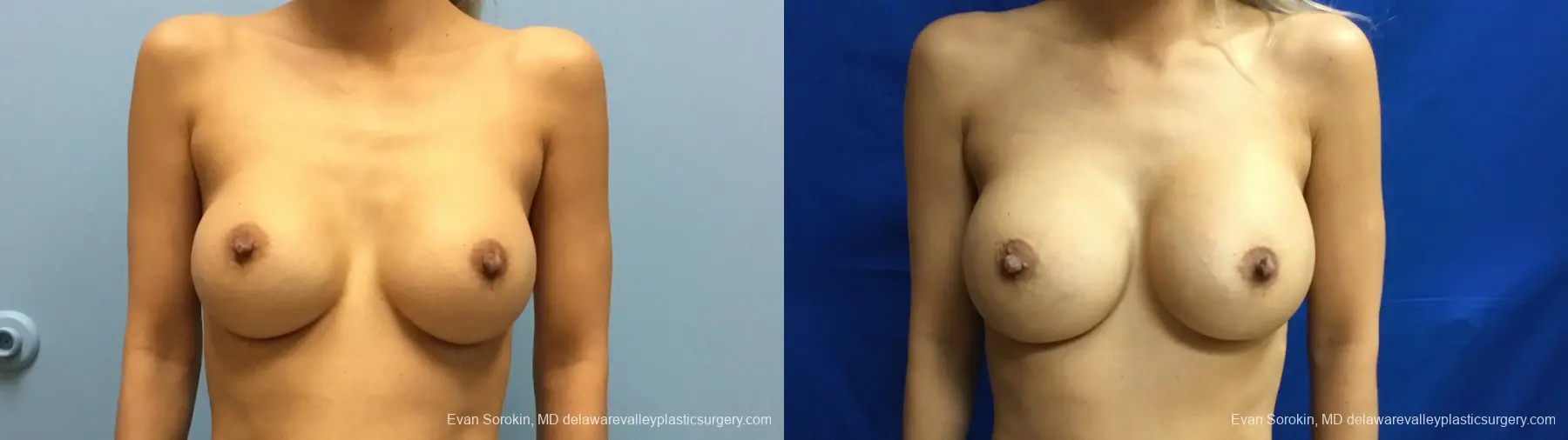 Philadelphia Breast Augmentation 13178 - Before and After 1