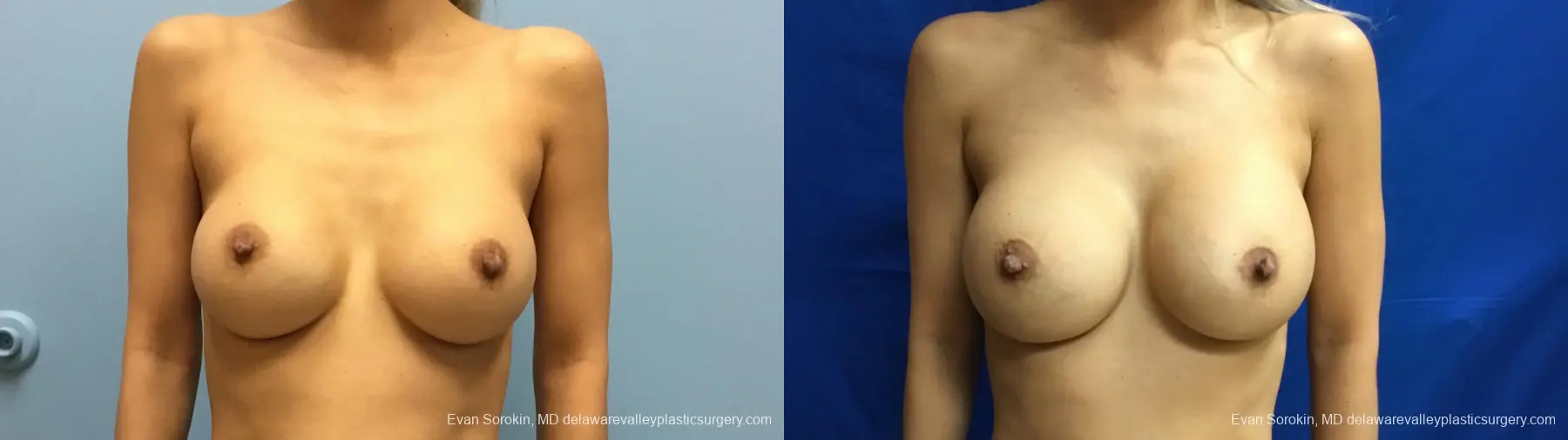 Philadelphia Breast Augmentation 13178 - Before and After