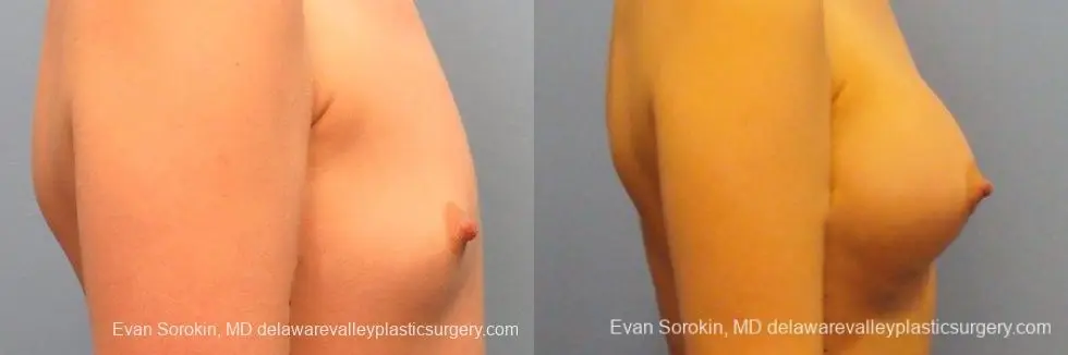 Philadelphia Breast Augmentation 10113 - Before and After 3