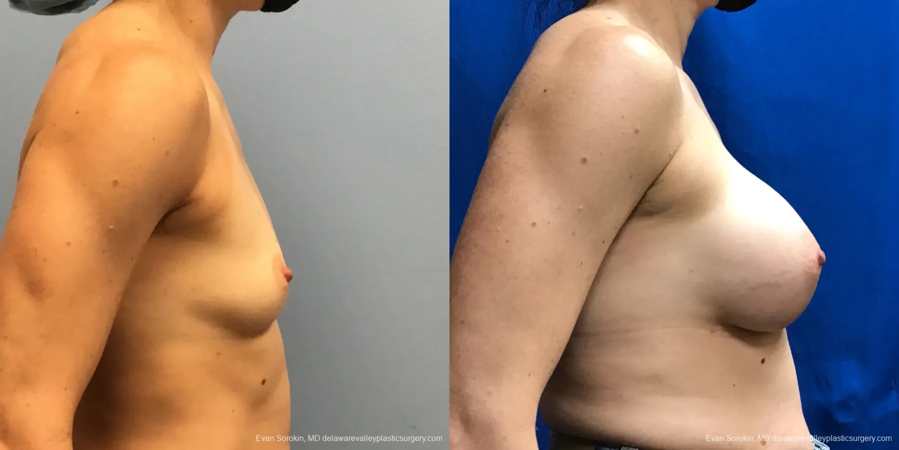 Breast Augmentation: Patient 183 - Before and After 3