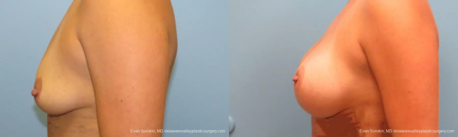 Philadelphia Breast Augmentation 9388 - Before and After 5