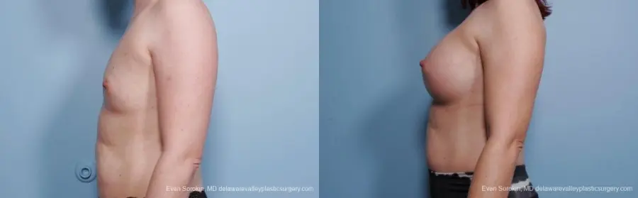 Breast Augmentation: Patient 54 - Before and After 5