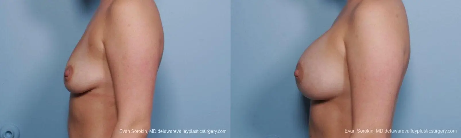 Philadelphia Breast Augmentation 9414 - Before and After 5