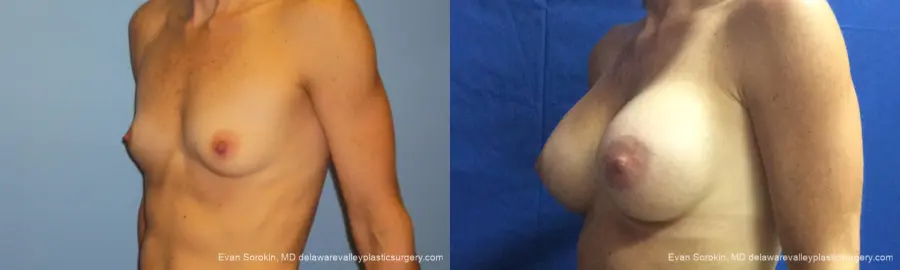 Philadelphia Breast Augmentation 10248 - Before and After 4