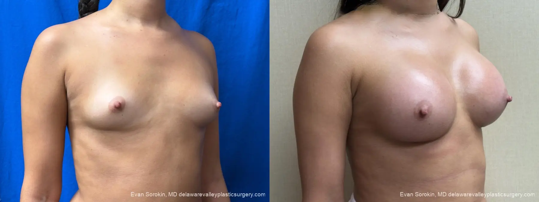 Breast Augmentation: Patient 283 - Before and After 2
