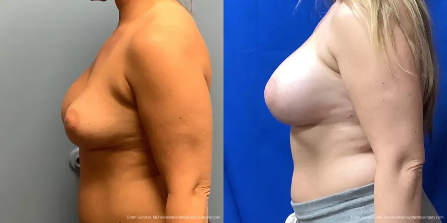Breast Augmentation Revision: Patient 32 - Before and After 3