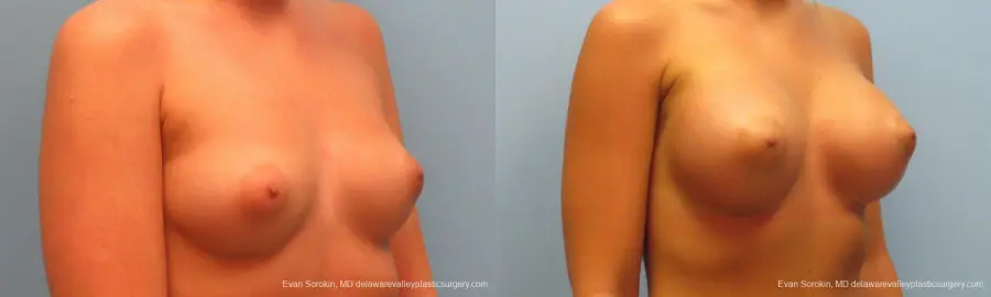 Breast Augmentation: Patient 12 - Before and After 2