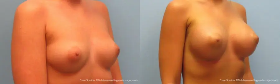 Breast Augmentation: Patient 11 - Before and After 2