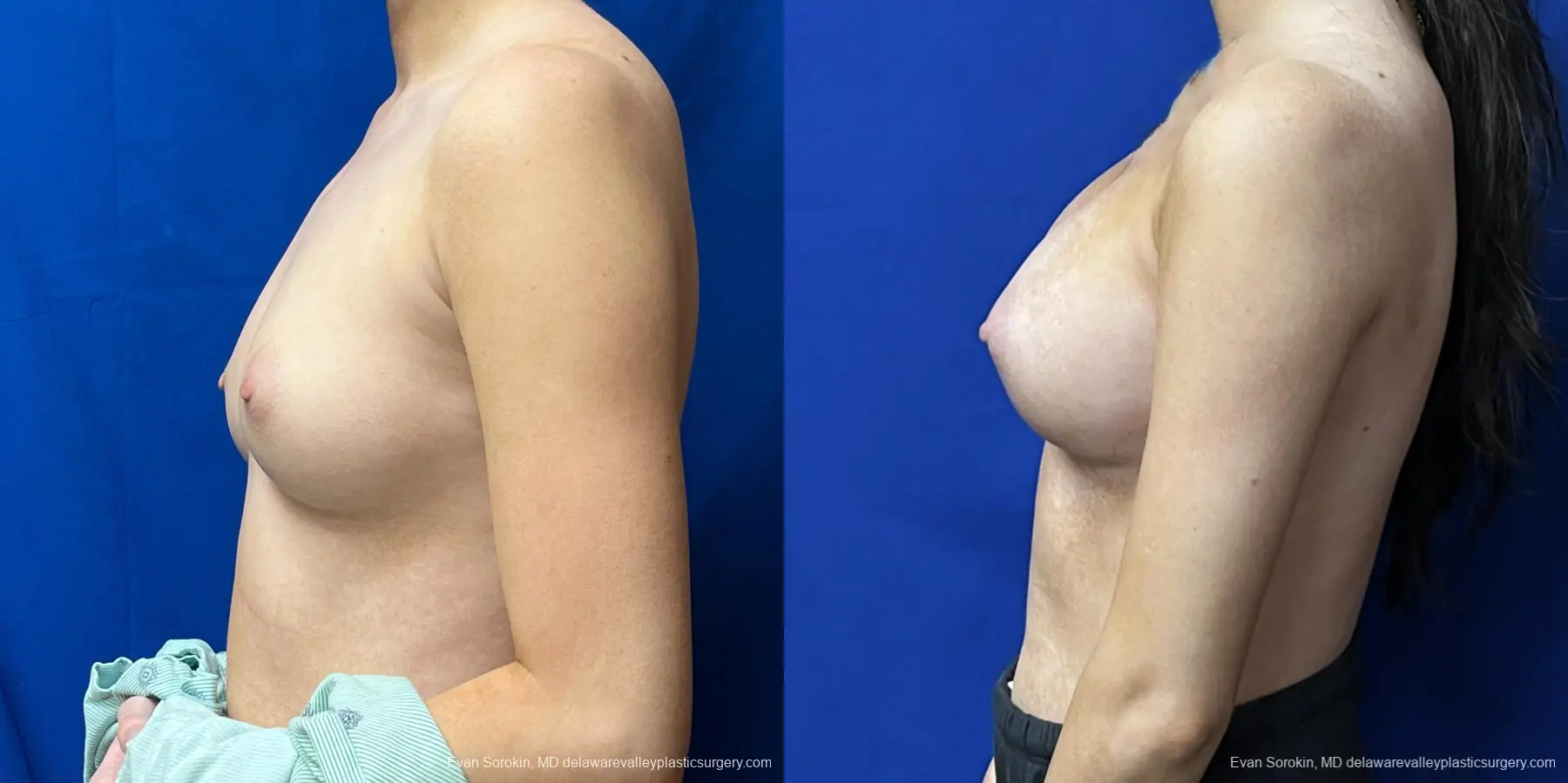 Breast Augmentation: Patient 215 - Before and After 5