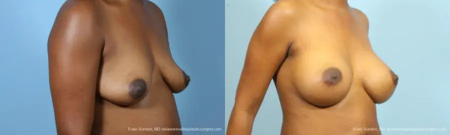 Philadelphia Breast Augmentation 9173 - Before and After 2