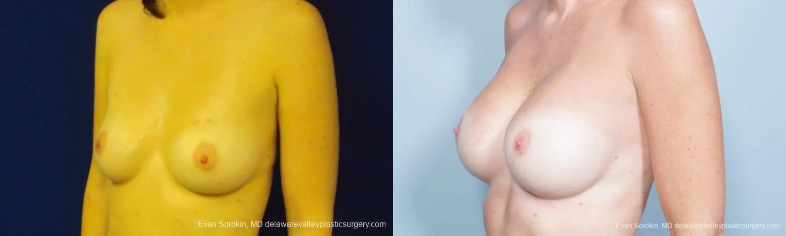 Philadelphia Breast Augmentation 8777 - Before and After 3