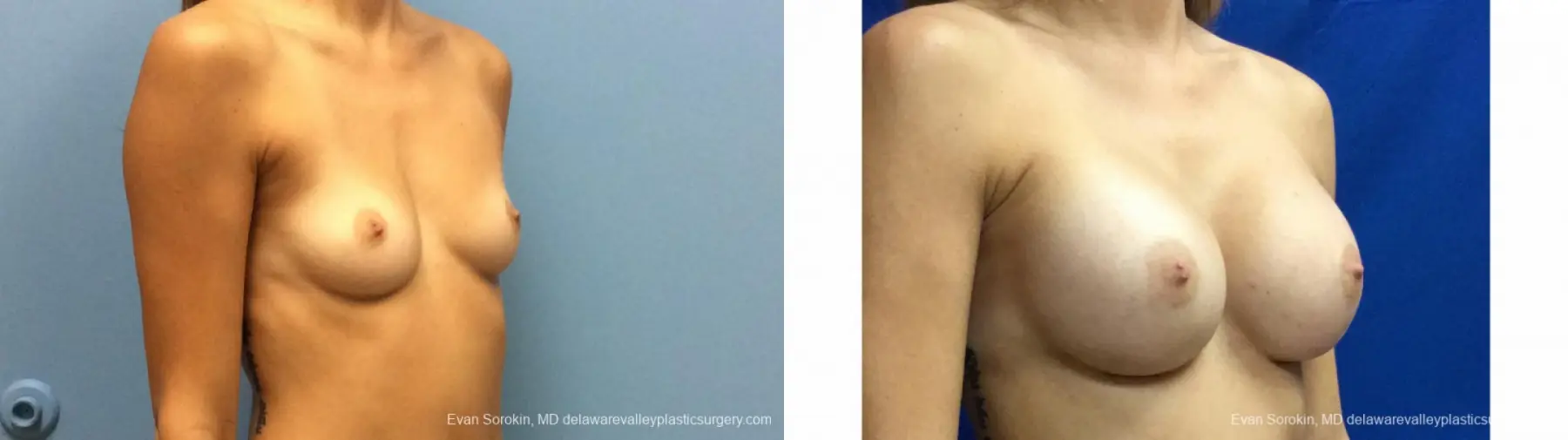 Philadelphia Breast Augmentation 13180 - Before and After 2