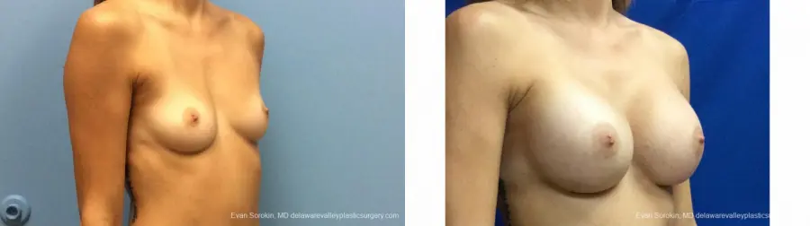 Philadelphia Breast Augmentation 13180 - Before and After 2