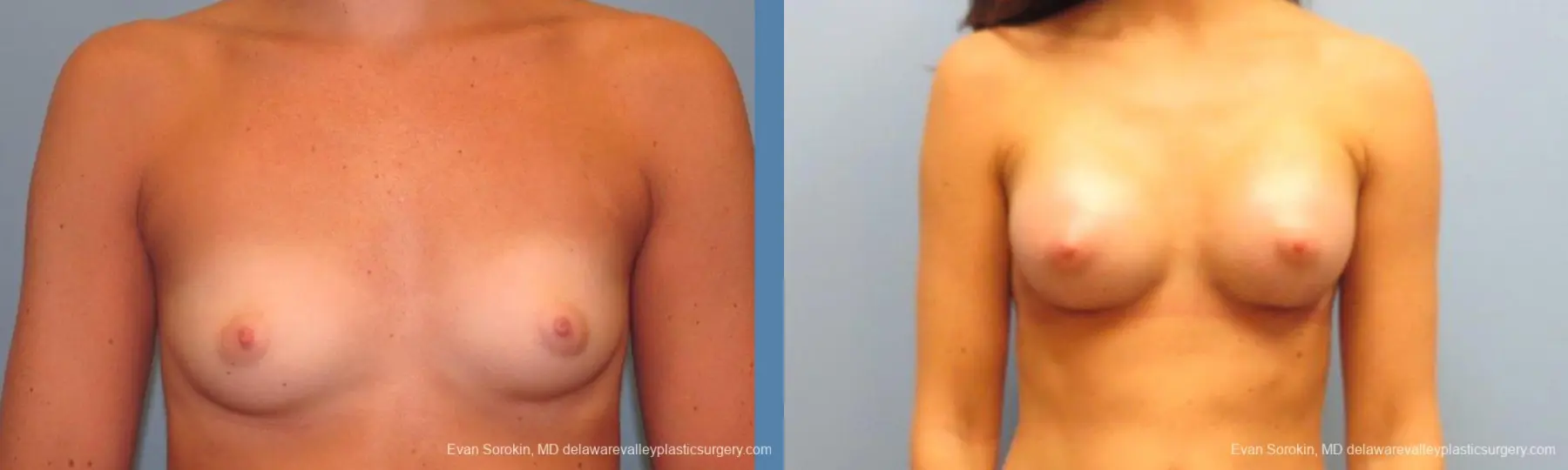 Philadelphia Breast Augmentation 9621 - Before and After 1