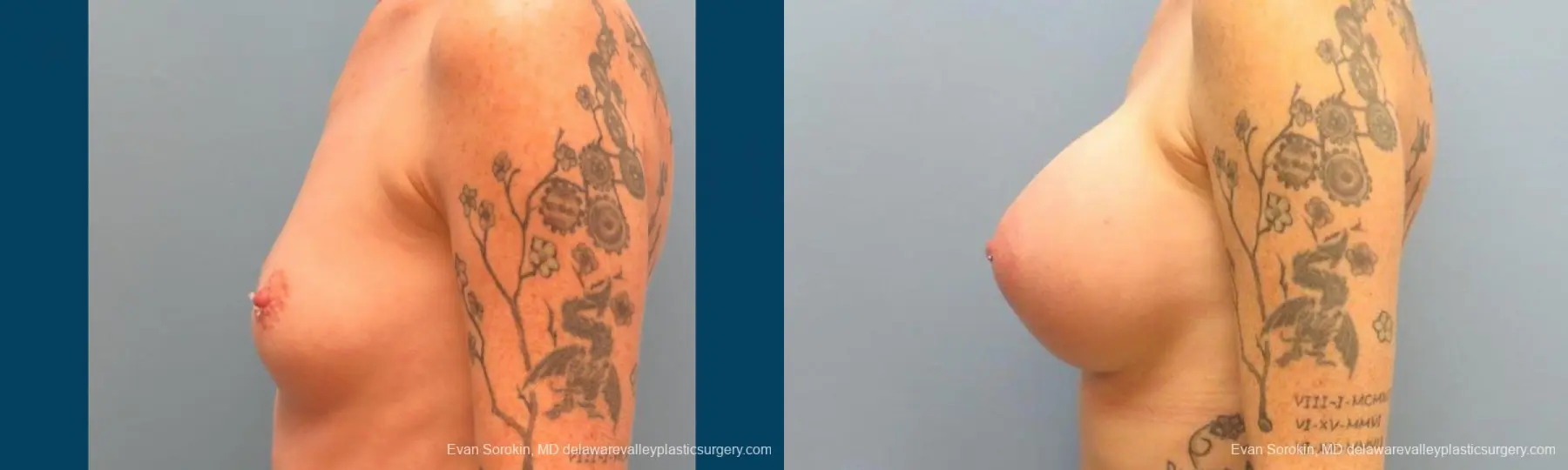 Philadelphia Breast Augmentation 9371 - Before and After 5
