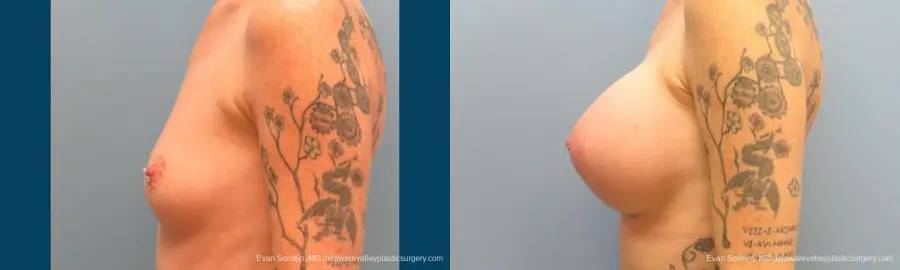 Philadelphia Breast Augmentation 9371 - Before and After 5