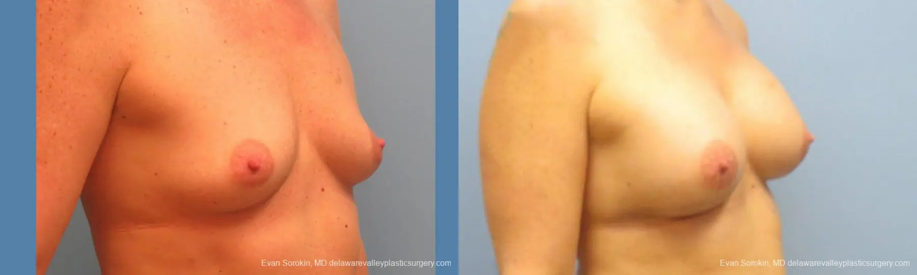 Philadelphia Breast Augmentation 9487 - Before and After 2