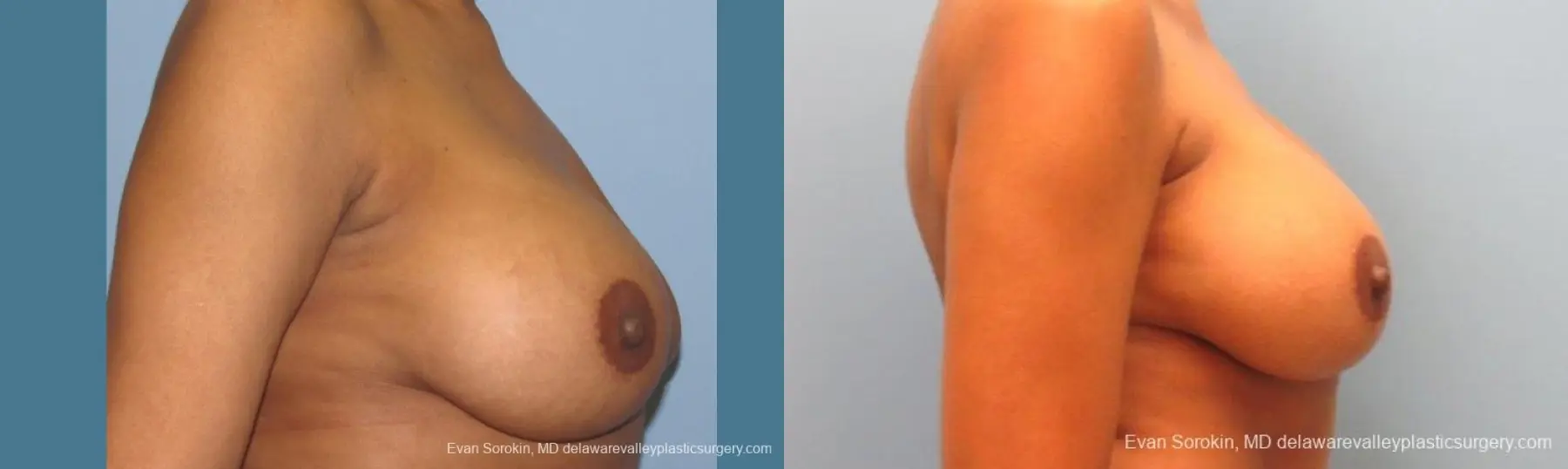 Philadelphia Breast Augmentation 10112 - Before and After 5