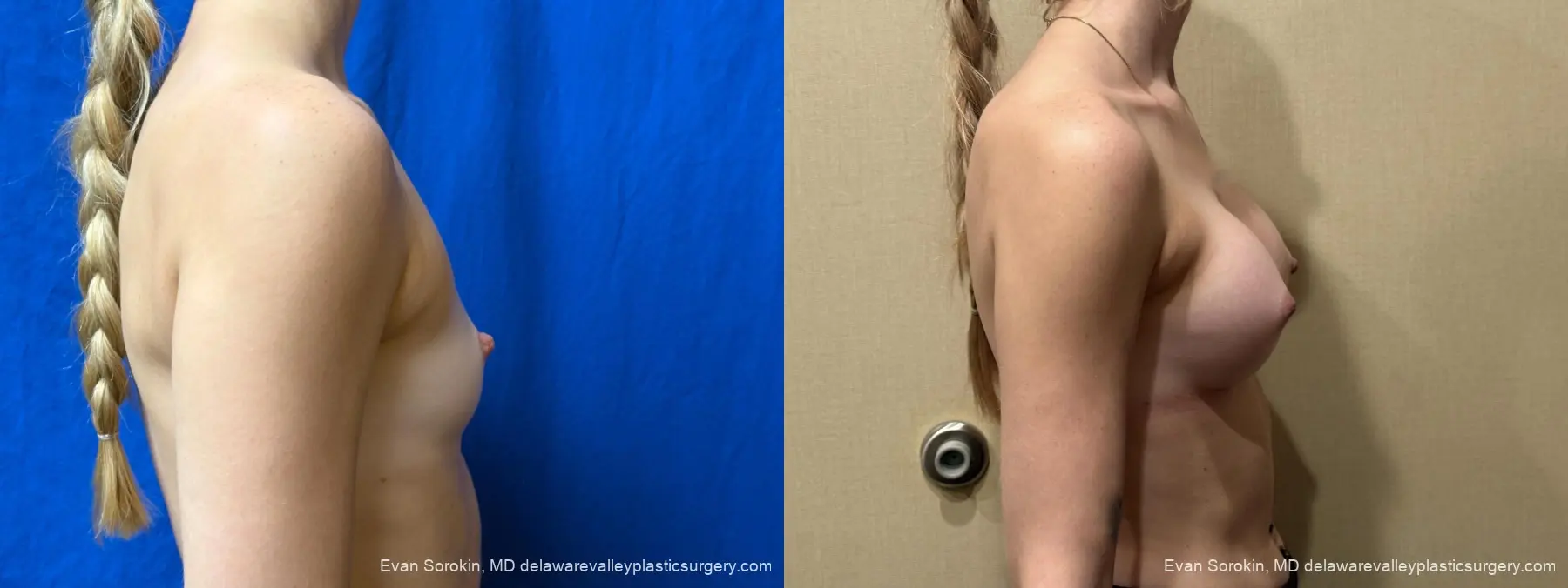 Breast Augmentation: Patient 267 - Before and After 3