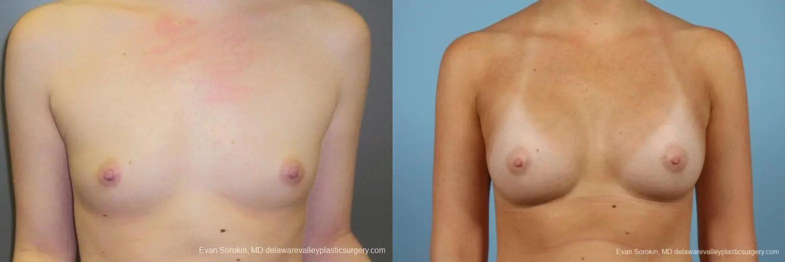 Philadelphia Breast Augmentation 8669 - Before and After 1