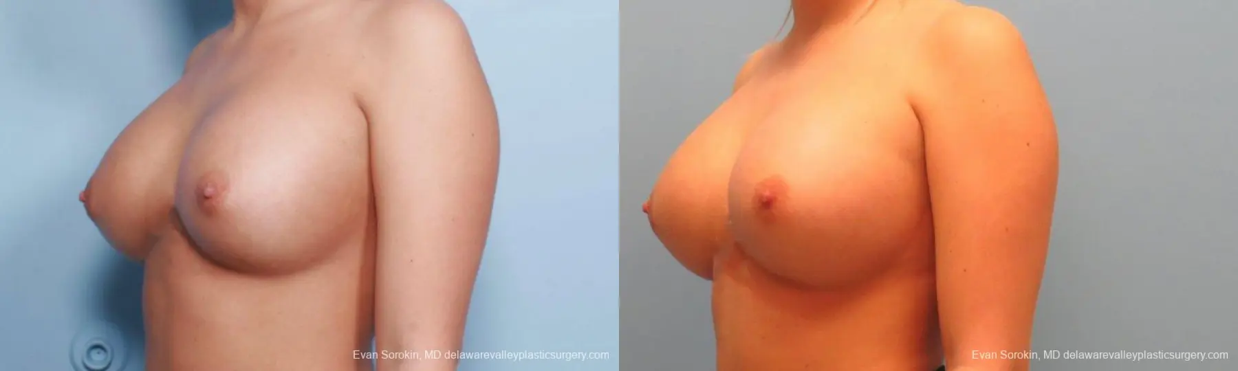 Philadelphia Breast Augmentation 9394 - Before and After 4