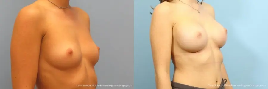 Philadelphia Breast Augmentation 8666 - Before and After 2