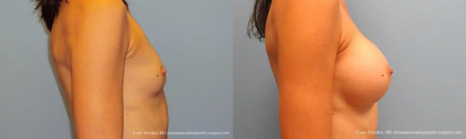 Philadelphia Breast Augmentation 9417 - Before and After 3