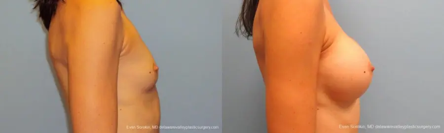 Philadelphia Breast Augmentation 9417 - Before and After 3