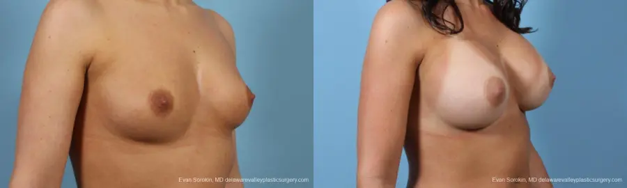 Philadelphia Breast Augmentation 8643 - Before and After 2