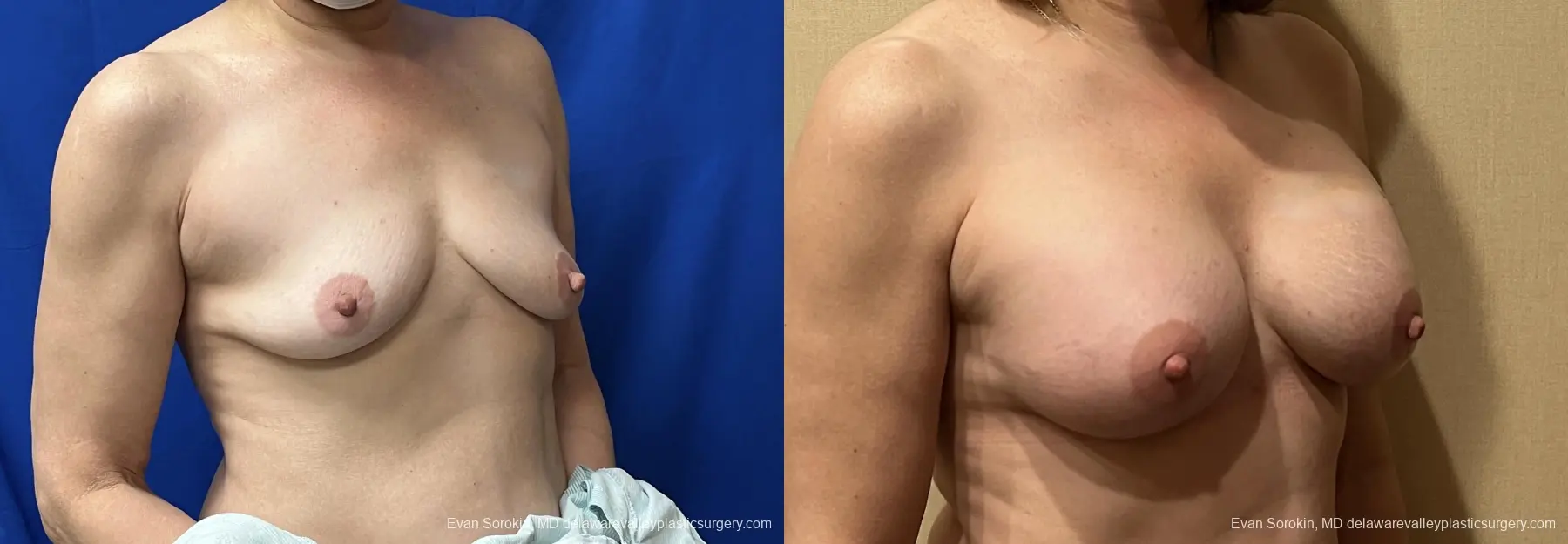 Breast Augmentation: Patient 255 - Before and After 2