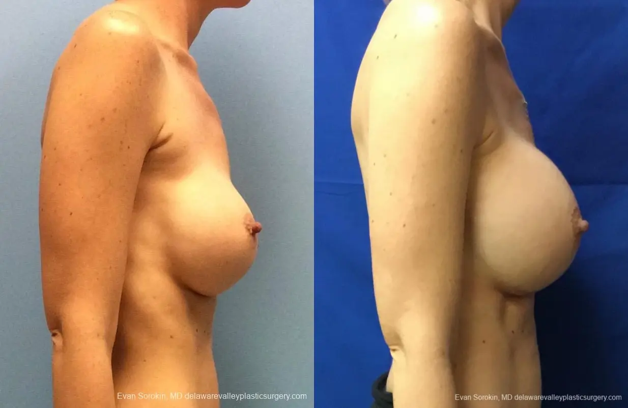 Philadelphia Breast Augmentation 13069 - Before and After 3