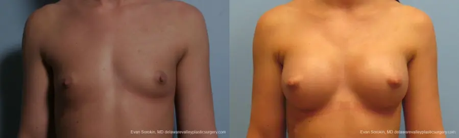 Philadelphia Breast Augmentation 8664 - Before and After 1