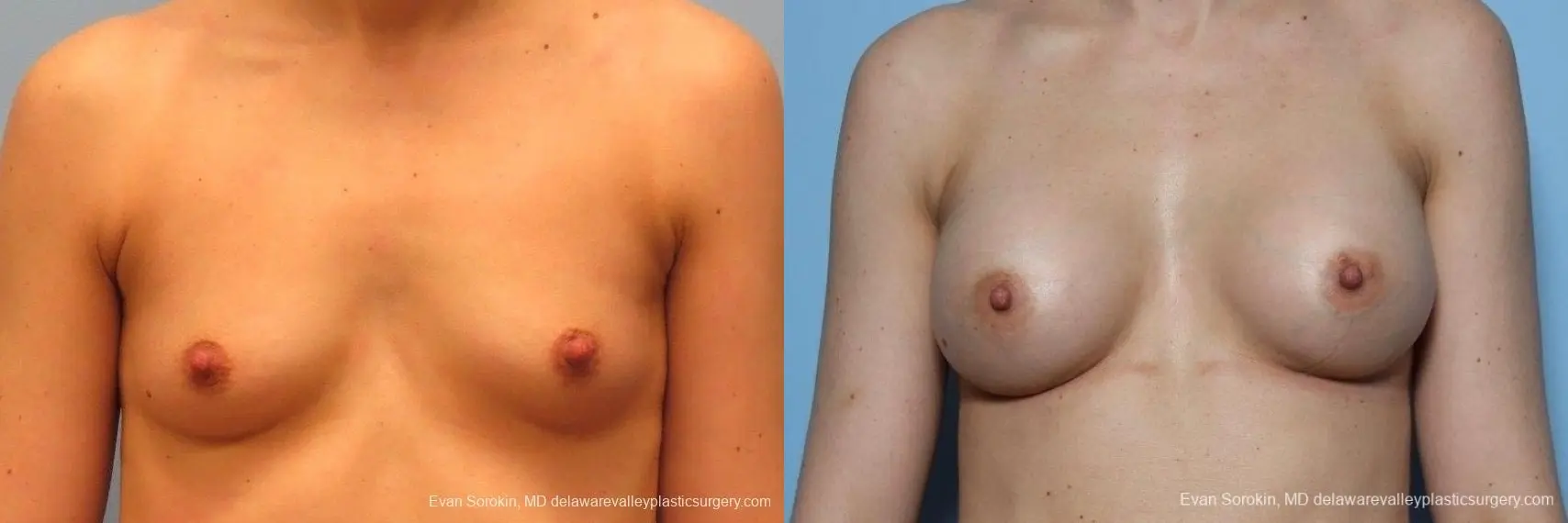 Philadelphia Breast Augmentation 8763 - Before and After 1