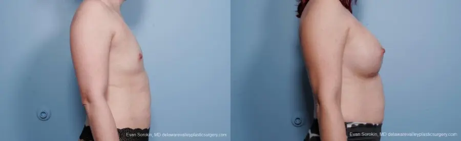 Breast Augmentation: Patient 54 - Before and After 3