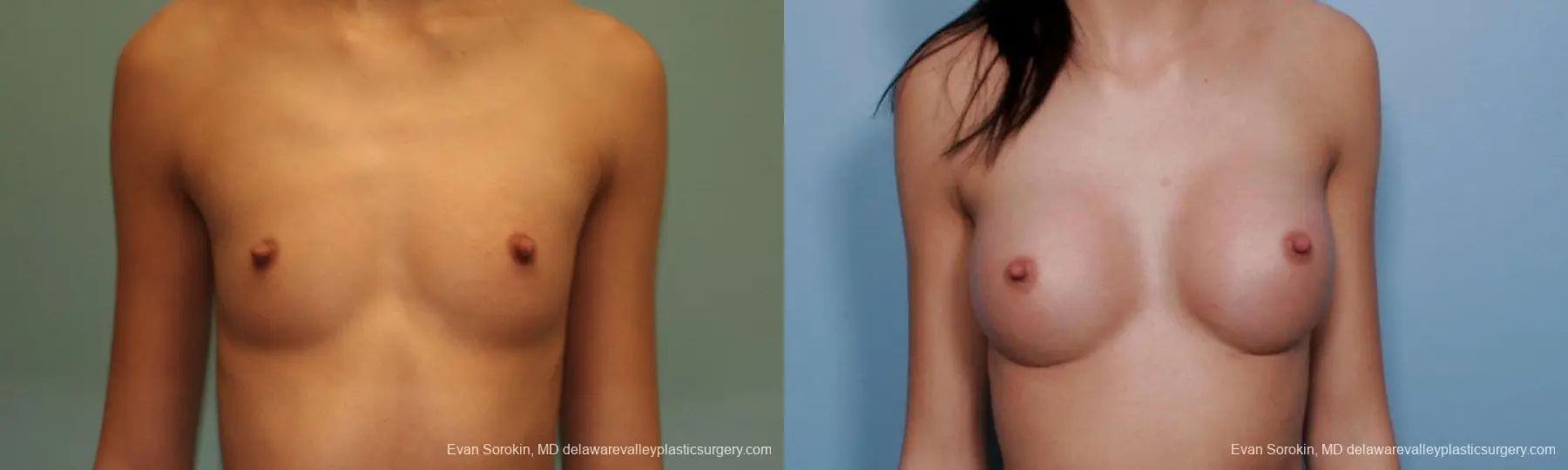 Philadelphia Breast Augmentation 9377 - Before and After 1