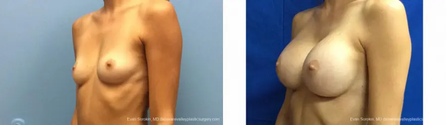 Philadelphia Breast Augmentation 13180 - Before and After 4